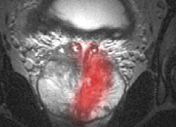 Cáncer de próstata resistente a la castración sin metástasis. Cáncer de próstata resistente a la castración sin metástasis.