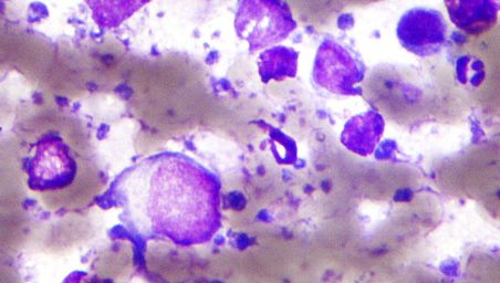 Imagen de una citología de linfoma de células B grandes difuso. 
