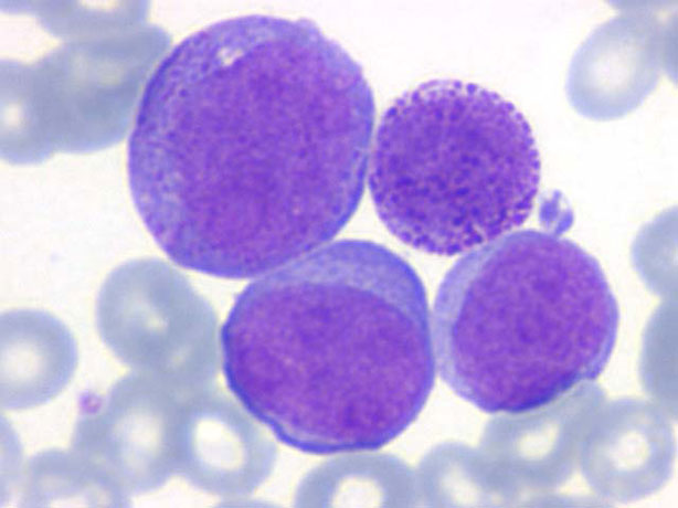 células de leucemia mieloide crónica 