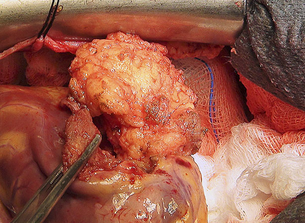 Imagen de un momento de la extracción del lipoma cardiaco. 