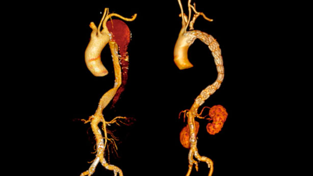 Disección crónica de aorta torácica descendente 