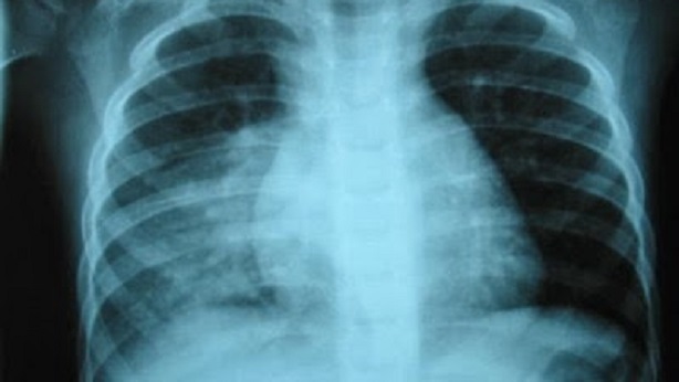 Radiografía torácica de una neumonía. 