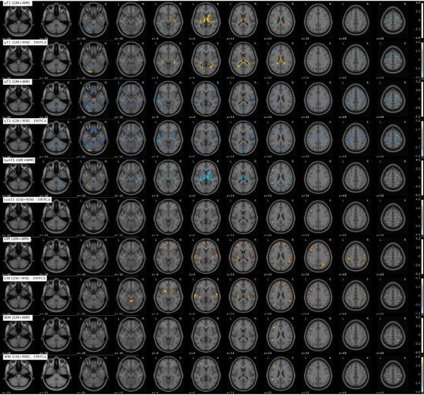 Resonancias Magnéticas (RM) cerebrales. Foto: DM 
