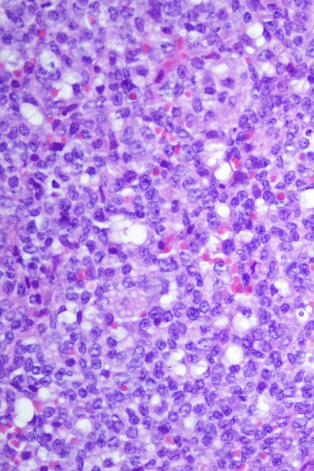 Células leucemia infantil 