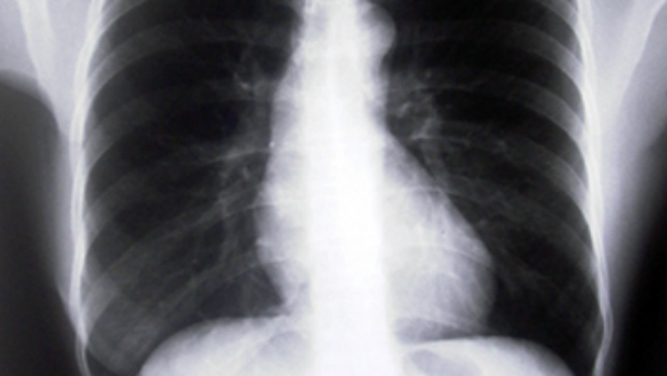 Radiografía de pulmón con EPOC. 