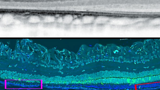 Imagen de OCT (arriba) y tinción inmunohistoquímica (abajo) del borde de la atrofia inducida en retina de cerdo; en el cuadro rosa, cambios morfológicos en el EPR de la retina atrófica. 