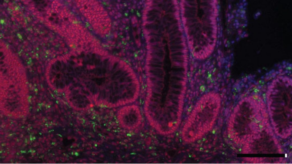 Intestino de paciente con Colitis Ulcerosa, una enfermedad intestinal inflamatoria crÃ³nica. En verde: marcador de macrÃ³fago, en rojo: proteÃna p38 activada, en azul: nÃºcleo.