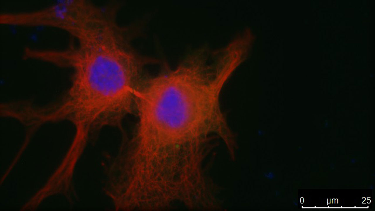 La sobreexpresión de PLK1 provoca un defecto en la separación de las células después de su división, impidiendo la proliferación celular y el crecimiento tumoral. 
