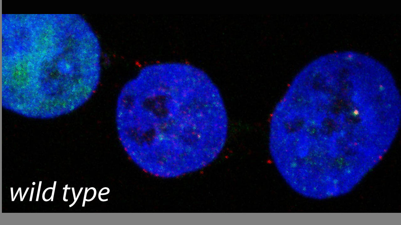 La inhibición de TLK conduce al estrés replicativo (verde) y a daño extensivo en el ADN (rojo) en células cancerosas cultivadas. 