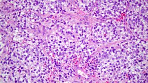 Sarcoma de Ewing. 