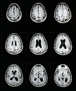 Imagen cerebral de esclerosis múltiple. 