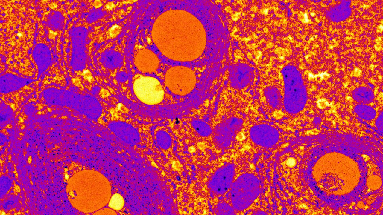 Autofagia deficiente de células hepáticas, tomadas con microscopio electrónico, que muestran la eliminación defectuosa de los desechos celulares