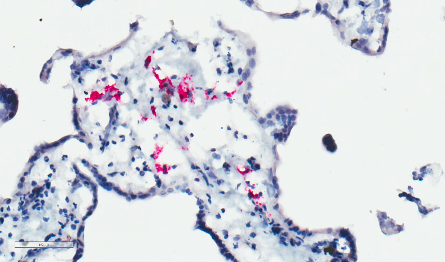 Macrófagos en una placenta infectada por el virus de Zika. 