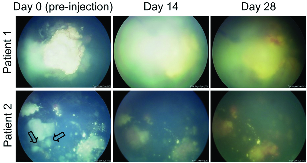 Imágenes del adenovirus por primera vez en el retinoblastoma de dos pacientes pediátricos. El virus se replicó sin causar inflamación.