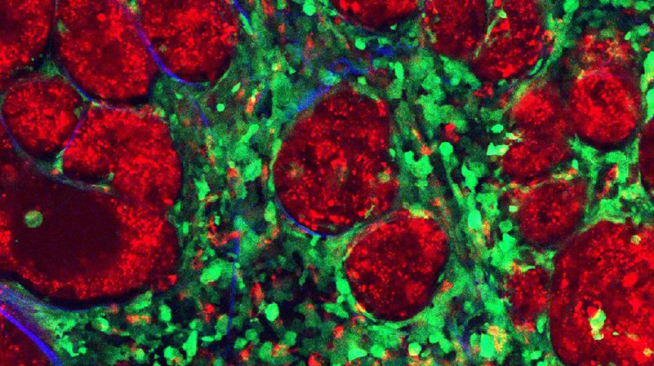 Componentes de un tumor: en rojo, células cancerígenas; en verde, células 