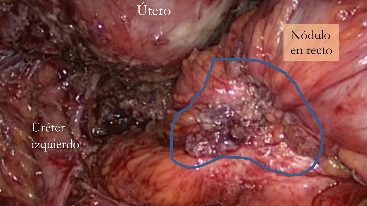 endometriosi dolore ano