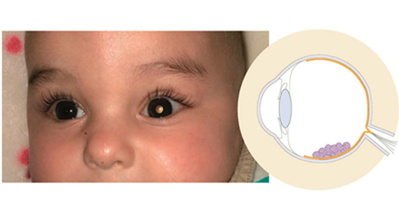 Ensayo piloto en retinoblastoma pediátrico.