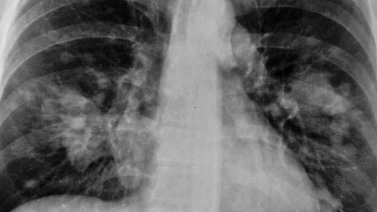keytruda y cáncer de próstata