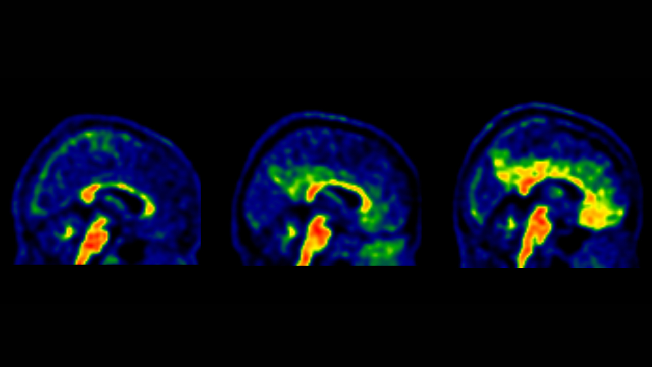 Reducen los valores de beta amiloide para identificar riesgo de ...