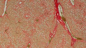 Hígado afectado por NASH, donde se aprecian gotas de grasa (blanco) y la fibrosis (rojo intenso).