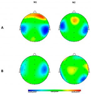 Comparación entre la activación cortical (picos N1 y N2 del potencial evocado sensorial) a estimulación eléctrica faríngea en voluntarios sanos (A) y un grupo de pacientes post-ictus con disfagia orofaríngea (B). Como se puede observar en la imagen, la activación cortial en voluntarios es simétrica y bilateral, mientras que en pacientes con ictus y disfagia es asimétrica y más difusa. 