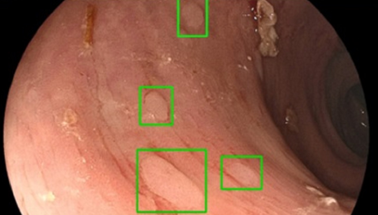Diagnostico colonoscopia de centro
