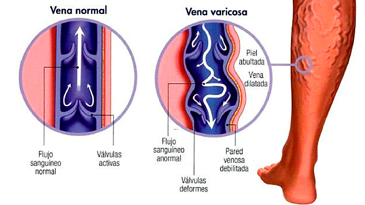 chirurg vascular în varicoza