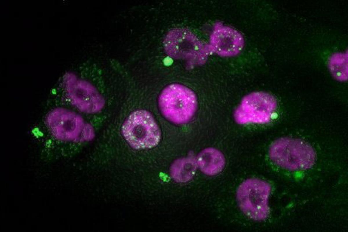 Células tumorales de adenocarcinoma de páncreas que muestran signos de daño en el ADN del núcleo y de micronúcleos, después de un tratamiento con taxol seguido de inhibidores de CDK4/6. 