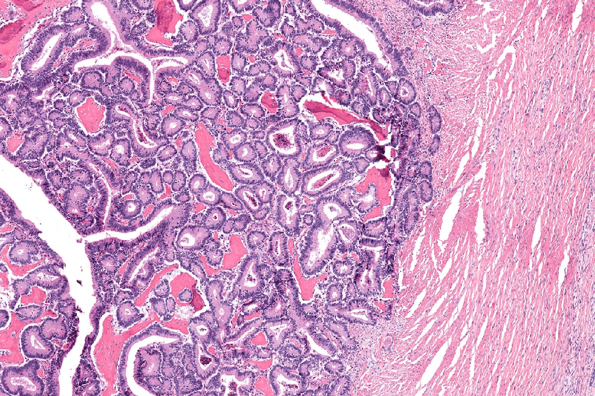 Imagen histológica de tejido con células cancerígenas de colon. 