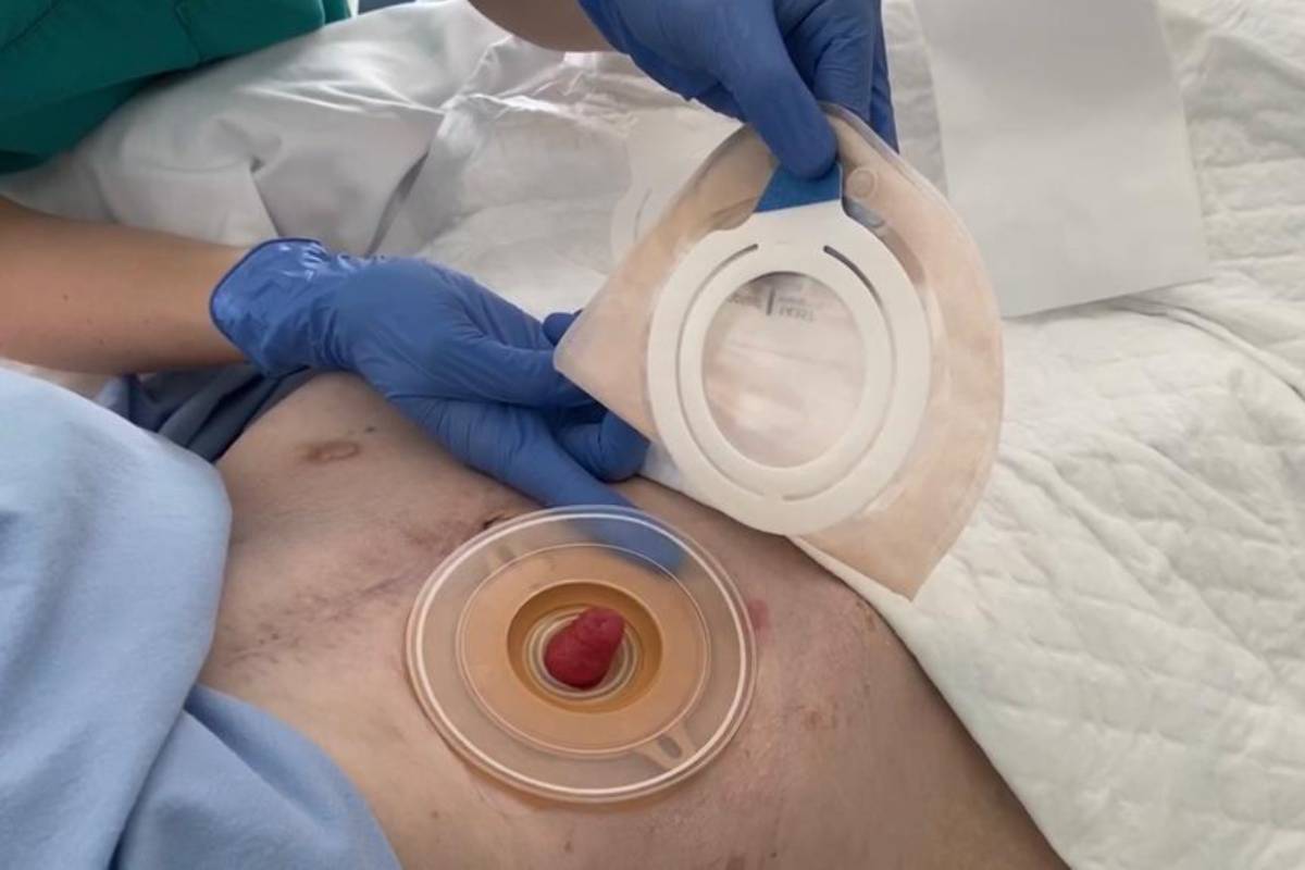 La Unidad de Ostomías del Hospital Universitario HM Sanchinarro (Madrid) ha creado el primer 'Manual de recomendaciones para pacientes ostomizados infectados por SARS-CoV-2 + y sus cuidadores'.