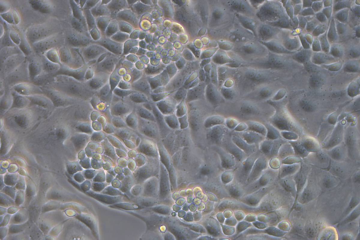 Líneas celulares de carcinoma seroso de alto grado de ovario 