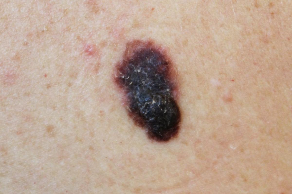 Imagen de un melanoma cutáneo