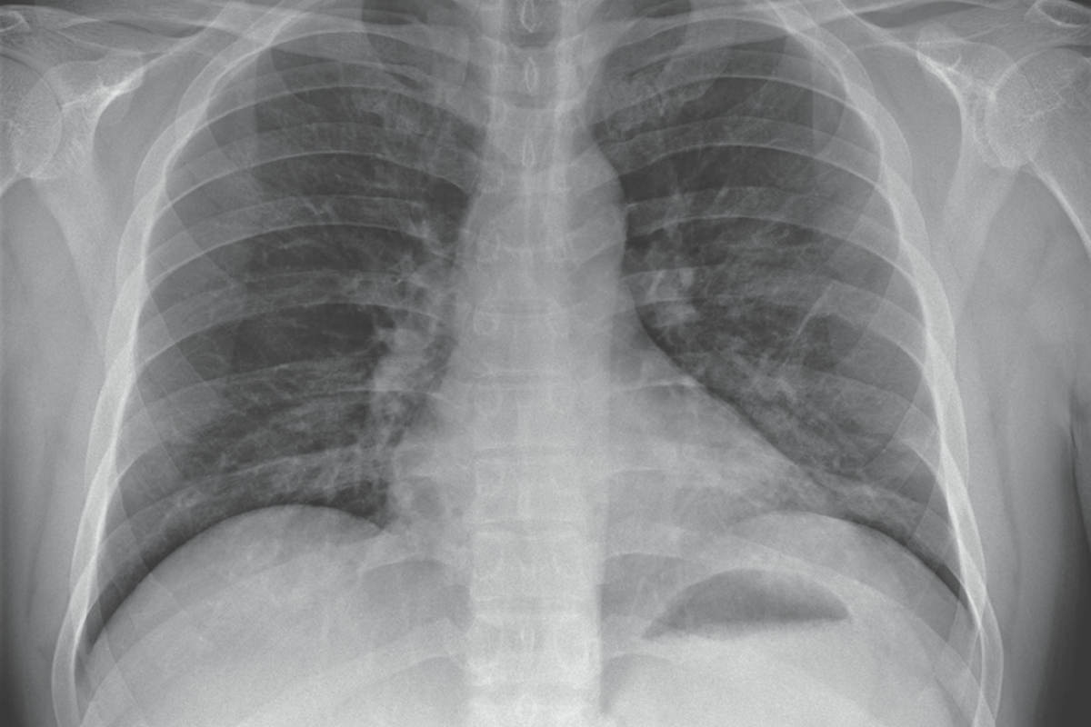 Radiografía pulmonar de un paciente con SARS-CoV-2. 