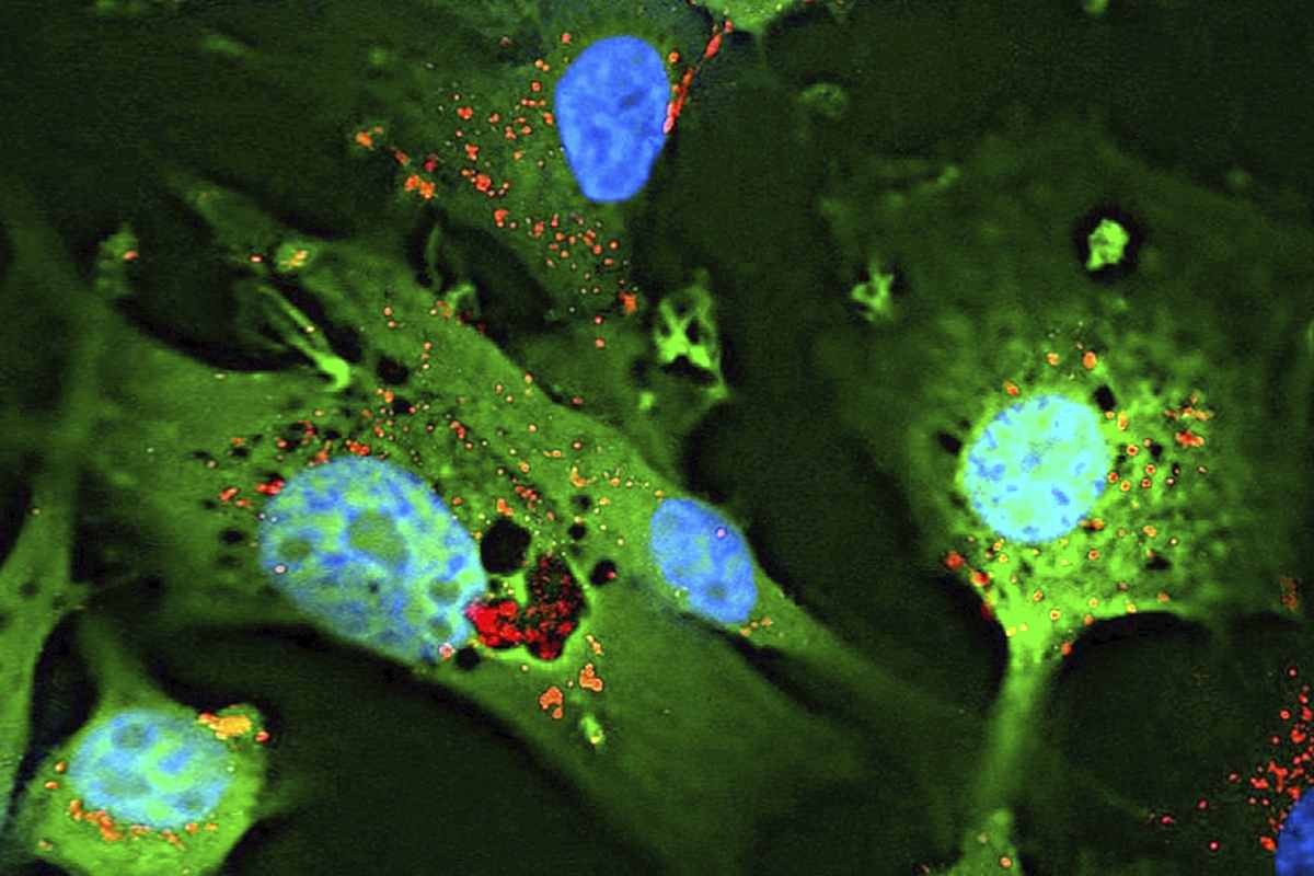 Cultivo de células de glioblastoma con proteína verde fluorescente