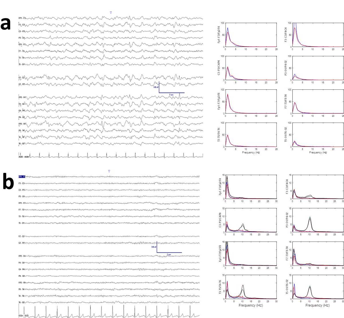 Registros EEG y análisis de los mismos. A) Registro de encefalopatía tóxica y B) registro de paciente con COVID. La columna de la derecha muestra los espectros de potencia promedio para cada canal. En rojo se muestran canales del hemisferio derecho y en azul del izquierdo. En el caso de del paciente COVID, se han superpuesto los espectros normalizados de un grupo control de personas sin patología para demostrar la diferencia con el registro mostrado, a pesar de que, visualmente, es un trazado que presenta m