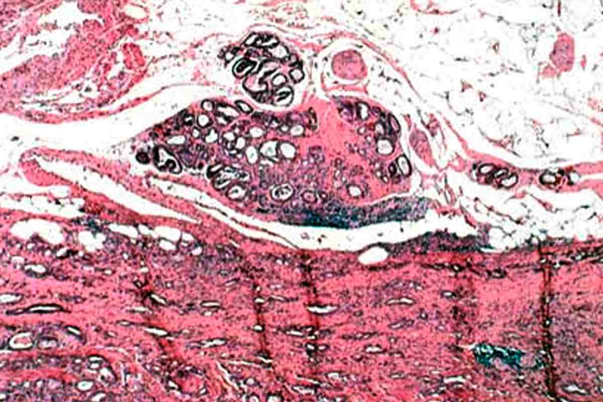 Células de cáncer de próstata. 