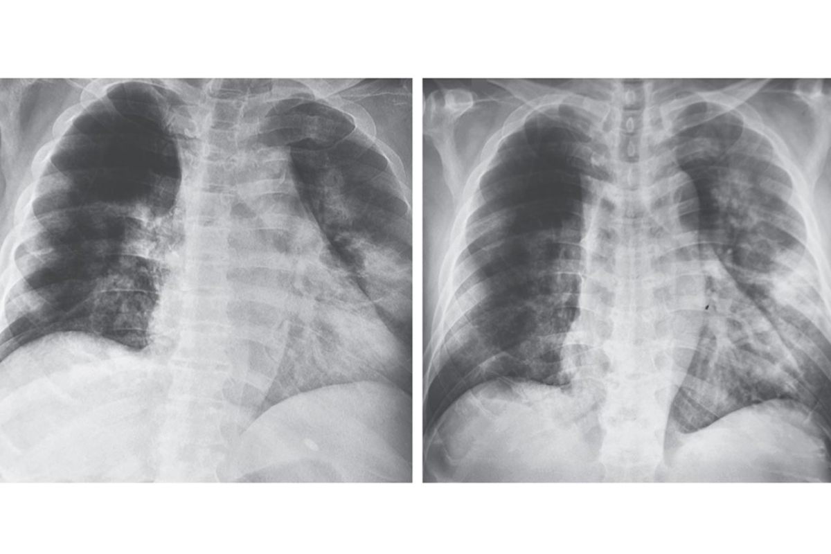 Radiografía de tórax de un caso de coronavirus.