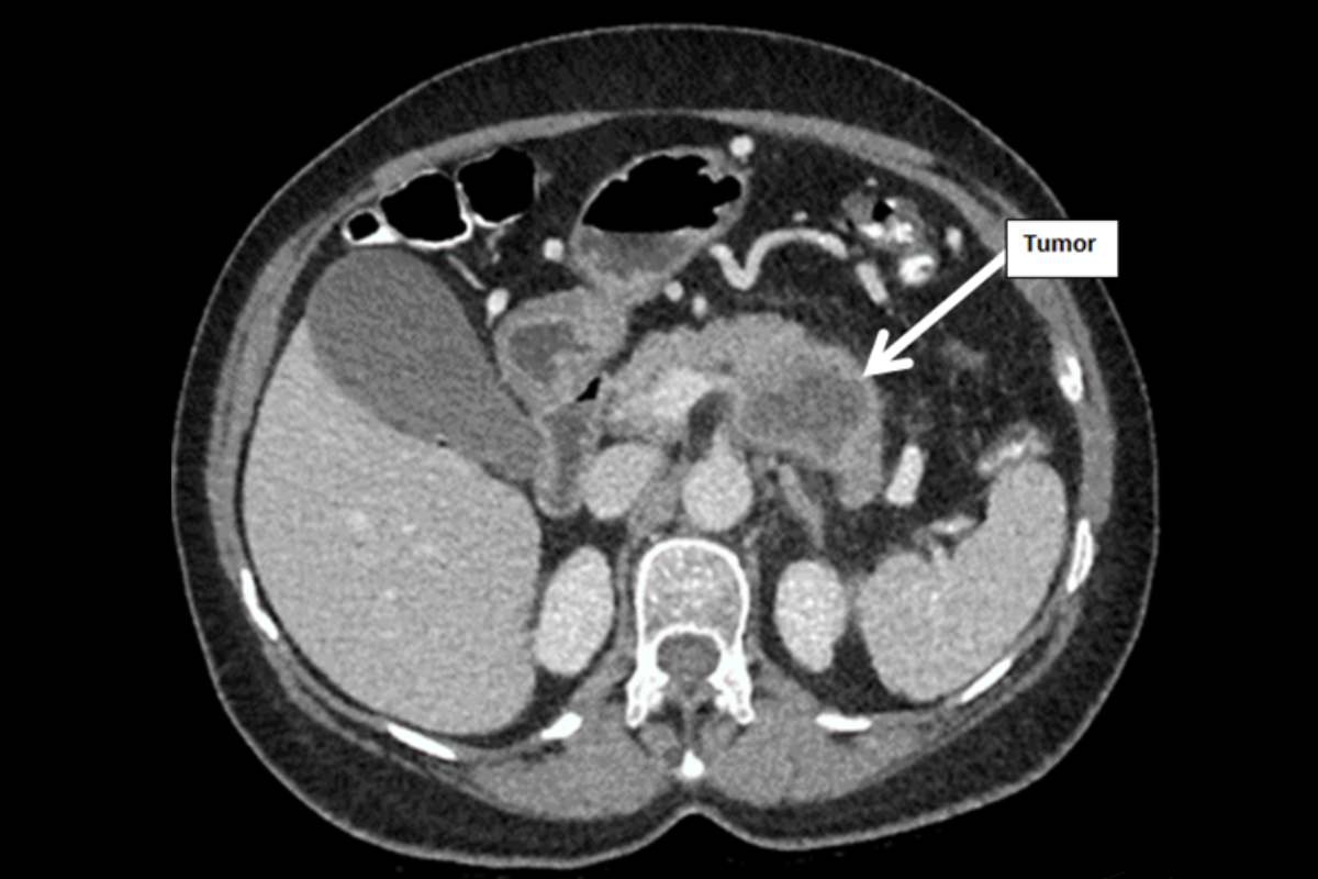 Imagen inicial del TAC en la que se ve un tumor en el páncreas