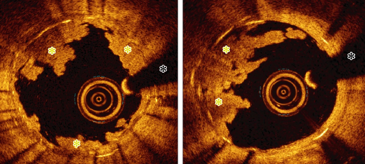 Trombosis de stent.