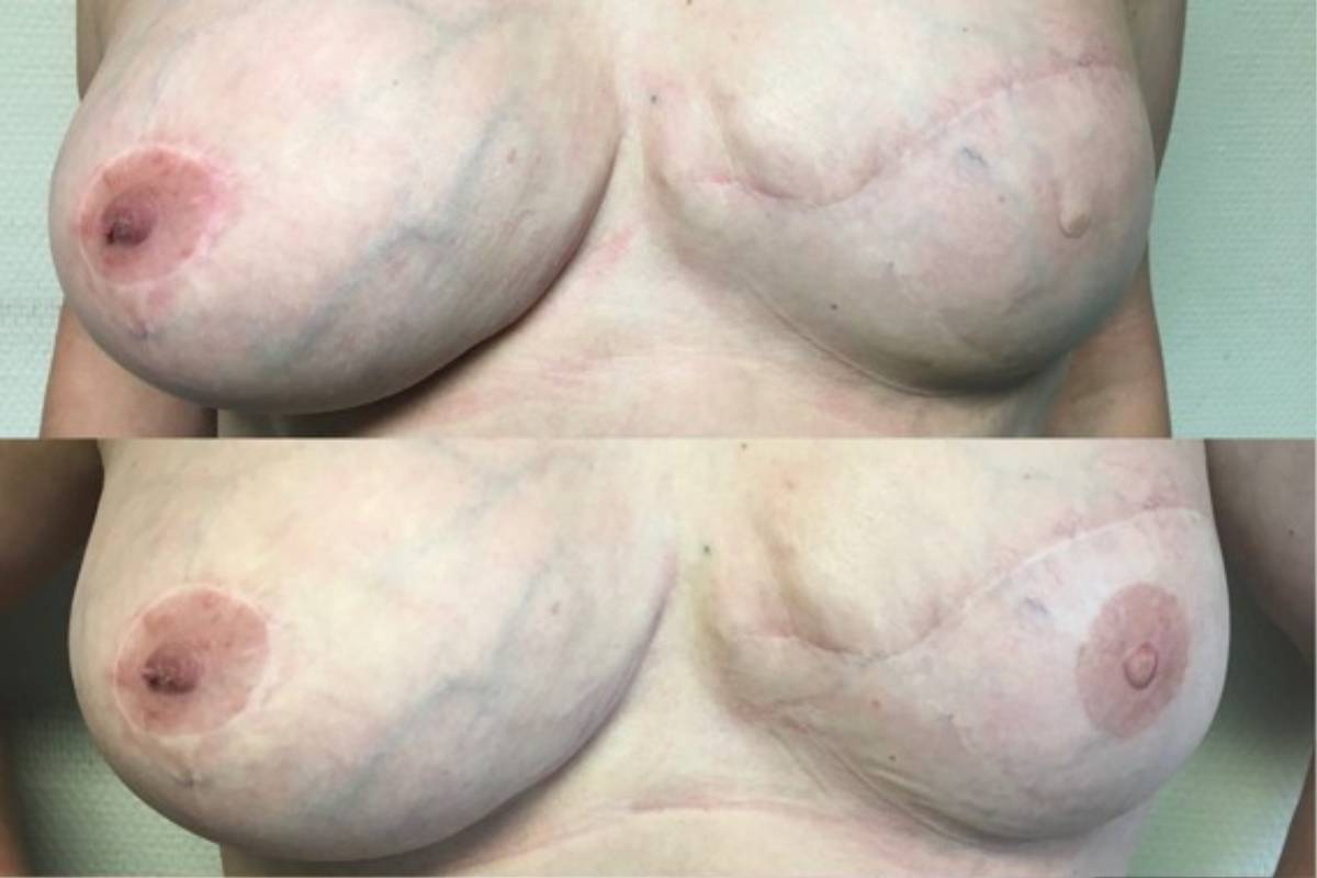 Antes y después de la micropigmentación de la areola y pezón.