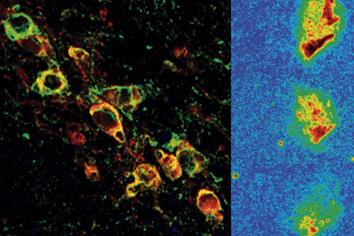 Neuronas dopaminérgicas expresando la forma humana de alfa-sinucleína vistas por microscopia confocal (izquierda) y reducción progresiva de la expresión de alfa-sinucleína después del tratamiento (derecha).