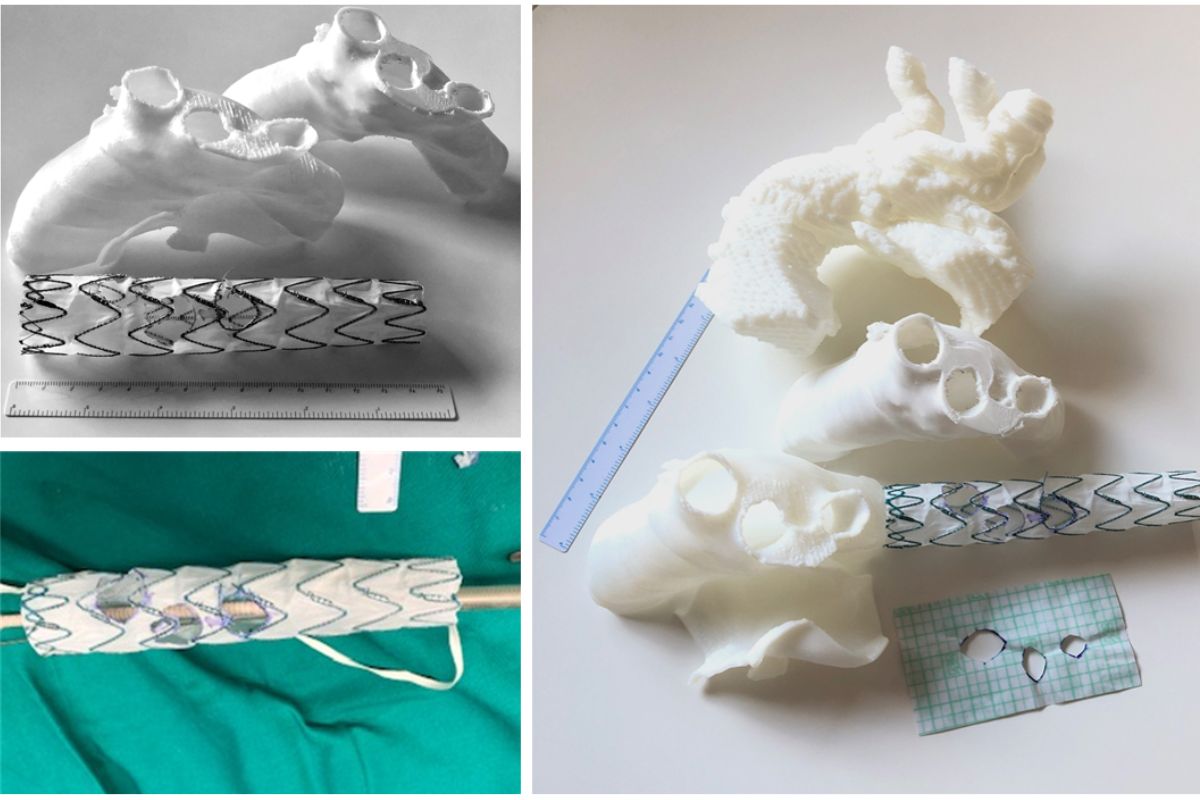 Modelos en 3D para aneurisma aórtico/ HM Hospitales. 