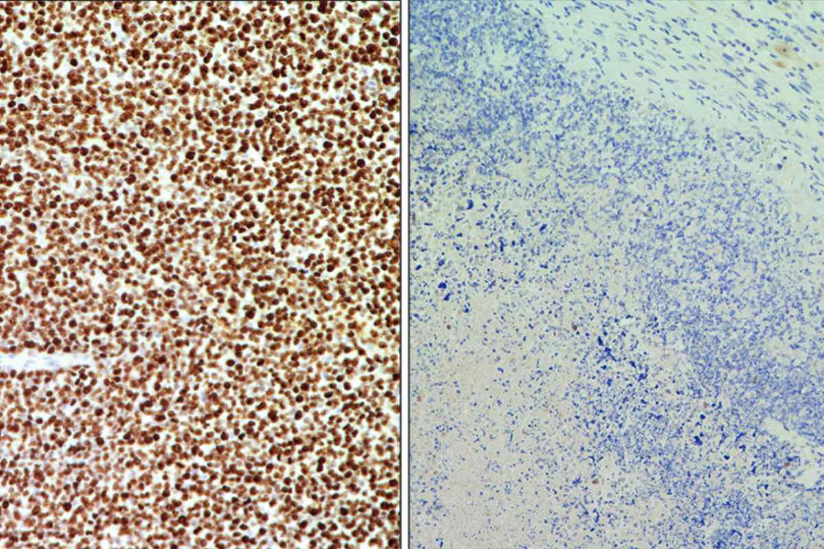 Imágenes representativas de un tumor no tratado (izquierda) comparado con otro tumor tratado (derecha) con el sistema de edición génica CRISPR para la eliminación de genes de fusión. Las células están teñidas con un marcador de proliferación celular (Ki67). La tinción marrón indica que el tumor no tratado está proliferando con rapidez, mientras que la ausencia de tinción (células en azul) indica que el tumor tratado con CRISPR ha detenido su crecimiento. /CNIO 