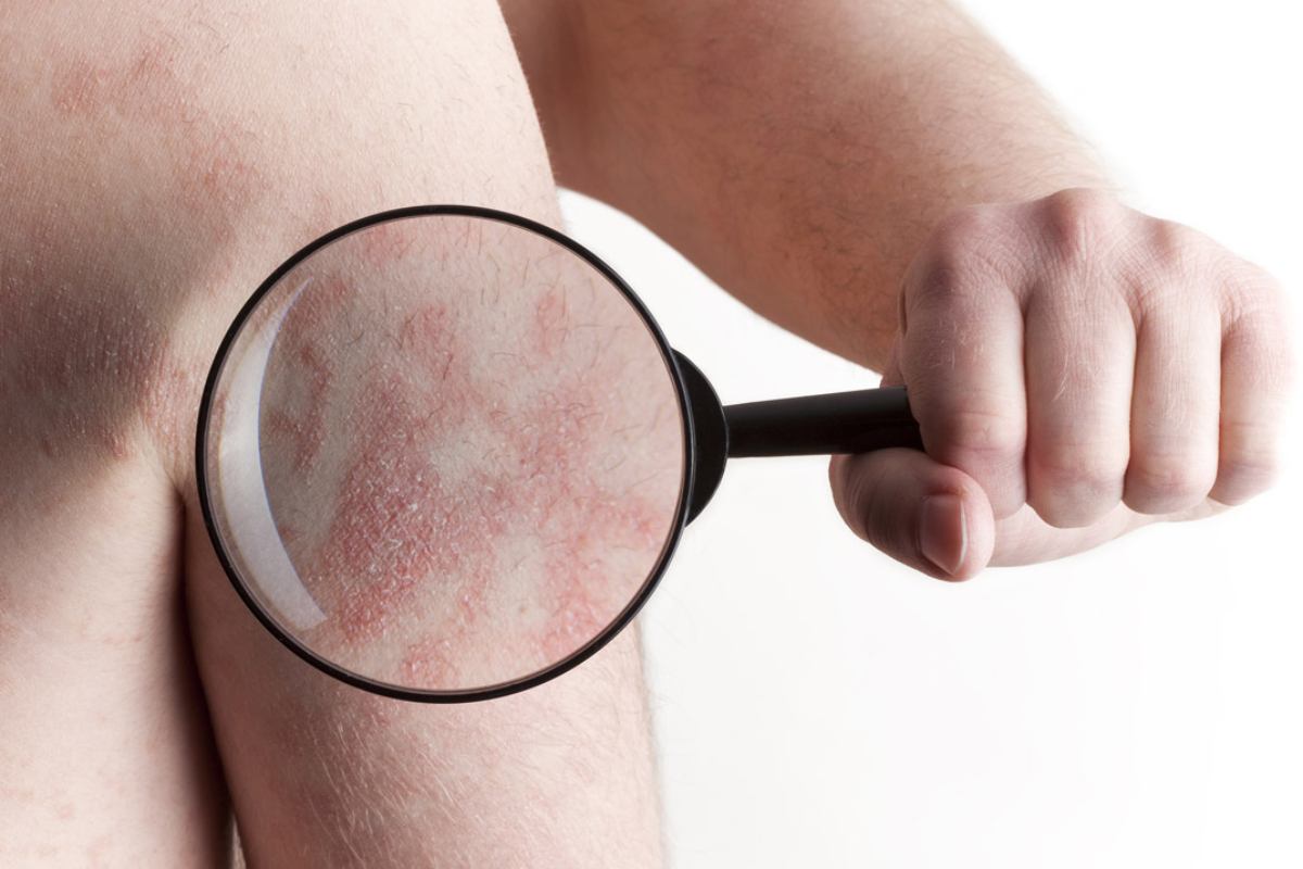 La dermatitis atópica cursa por brotes y se manifiesta por un picor intenso. 