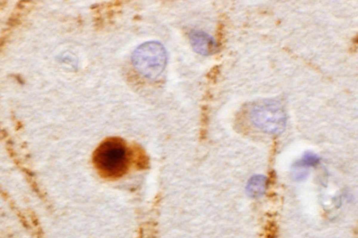 Células en un cerebro con Parkinson. 
