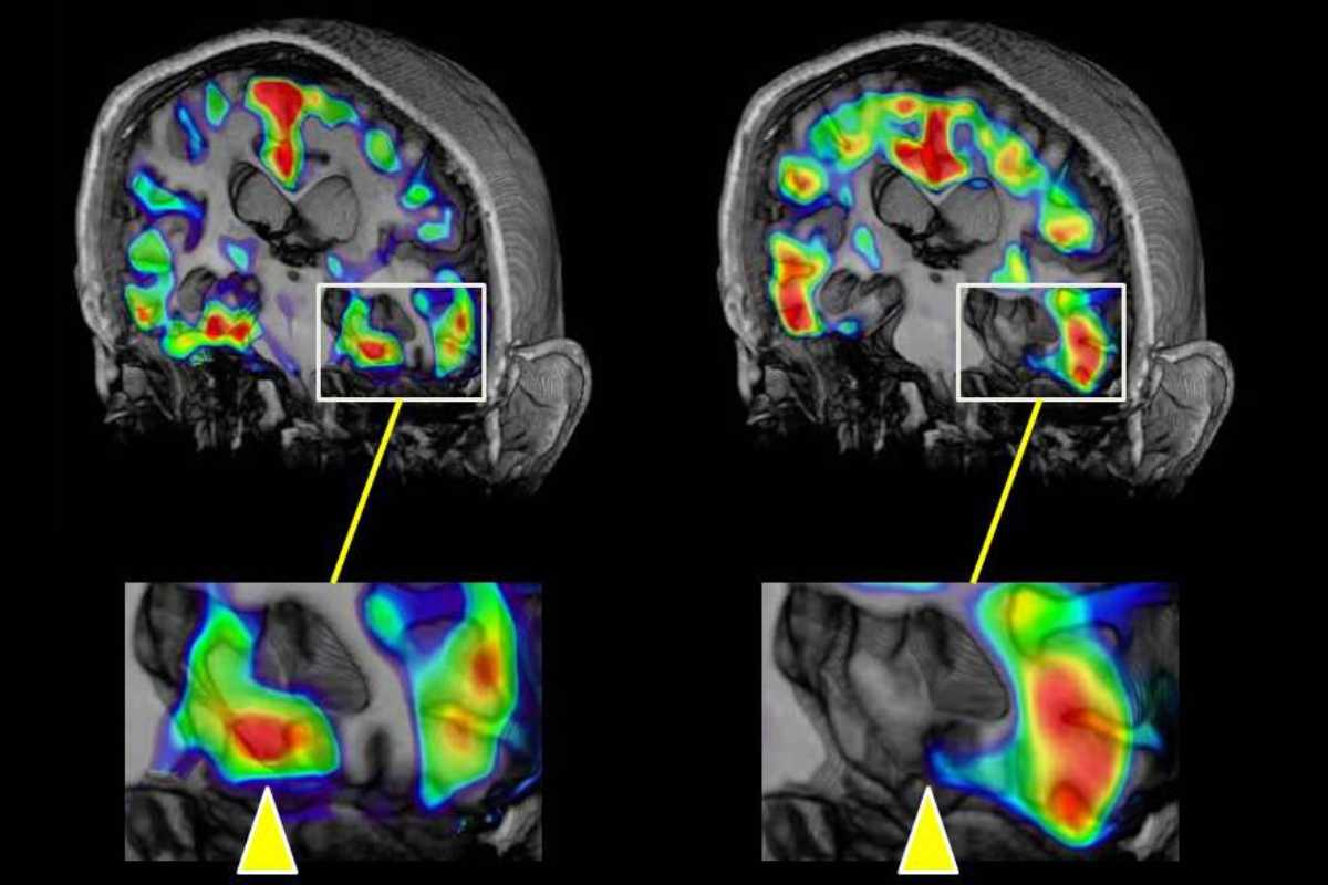 Contraste para visualizar los estragos del Alzheimer en el cerebro. 
