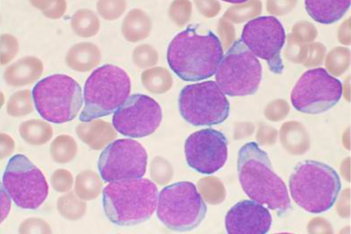 Frotis aspirado de médula ósea afectada de leucemia linfoblástica aguda de células B. 