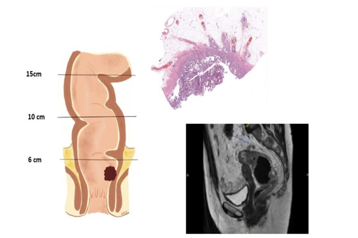 Cáncer colorrectal.