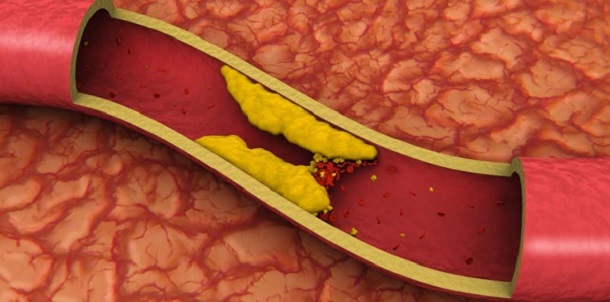 Los depósitos de colesterol en sangre, causa de HF. 