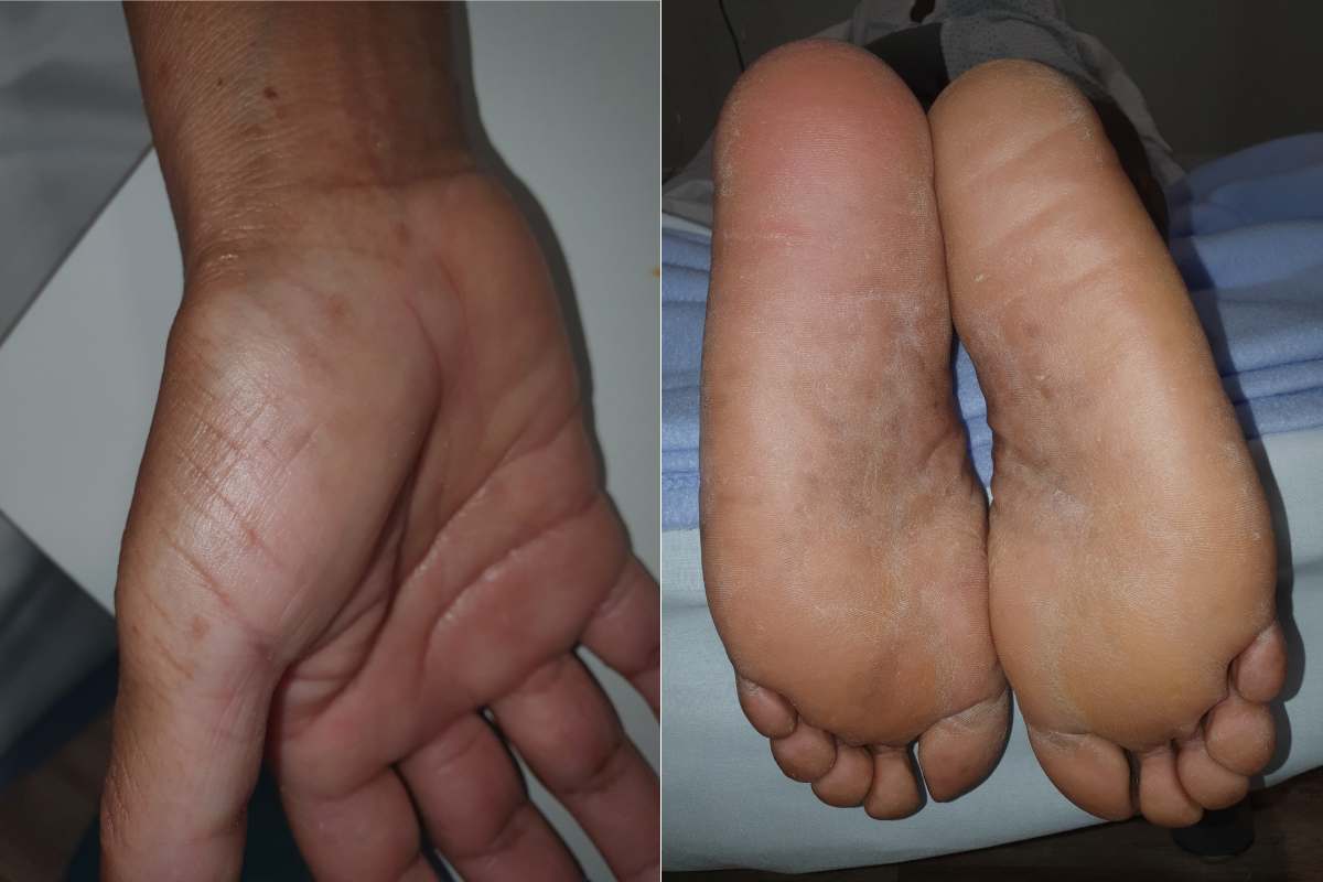 Sensación de ardor y rojez en palmas de manos y plantas pies asociado a covid-19.